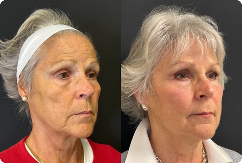 NeoGen #9 Combined Image