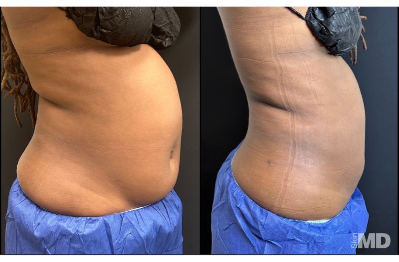 BodyTite Liposuction #7