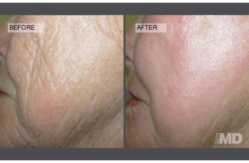 CO2RE® Laser Resurfacing #1