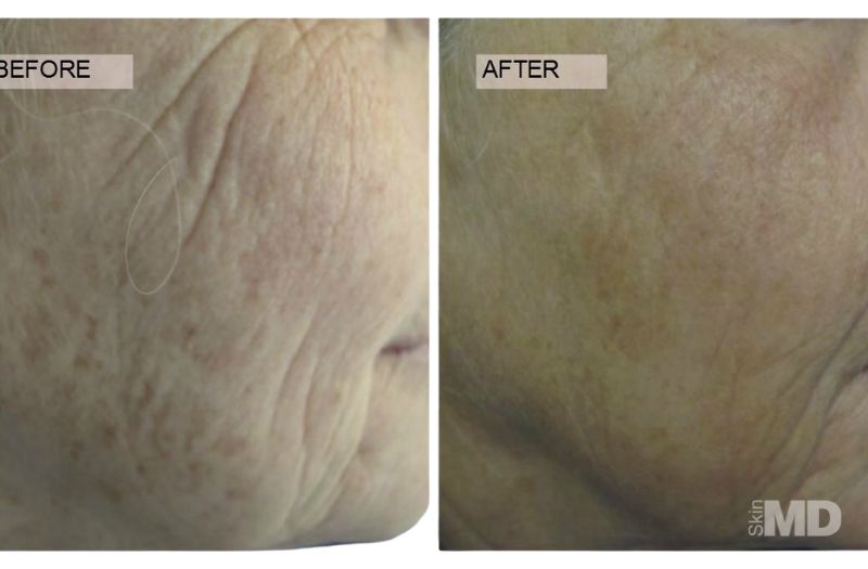 CO2RE® Laser Resurfacing #2