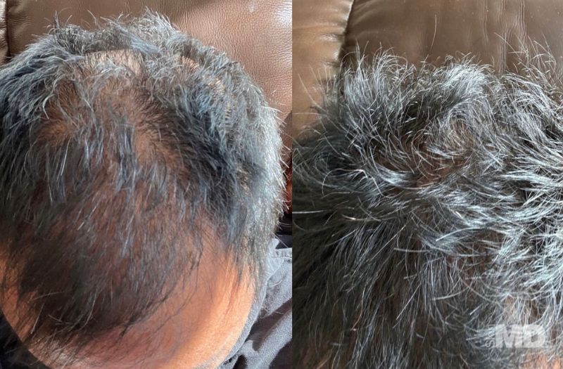 Hair Restoration #4
