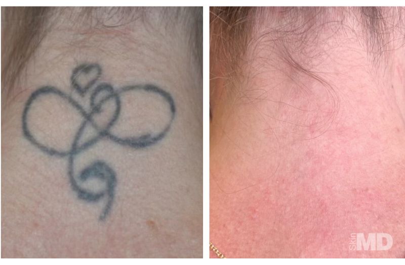 Tattoo Removal #4