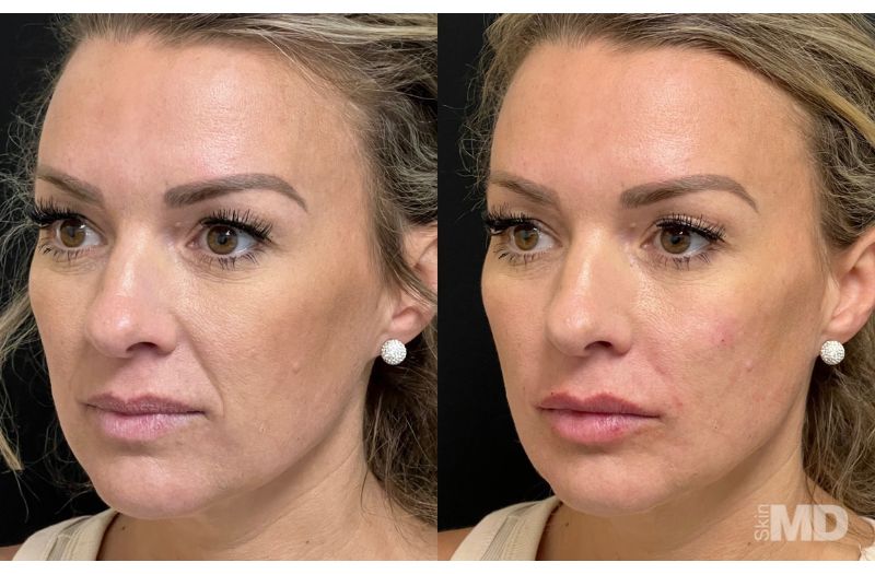 Dermal Filler – Lips #5