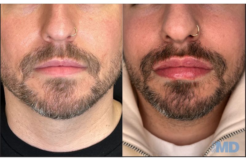 Dermal Filler – Lips #7