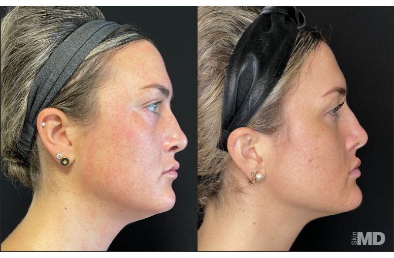 Morpheus8 – Face #1