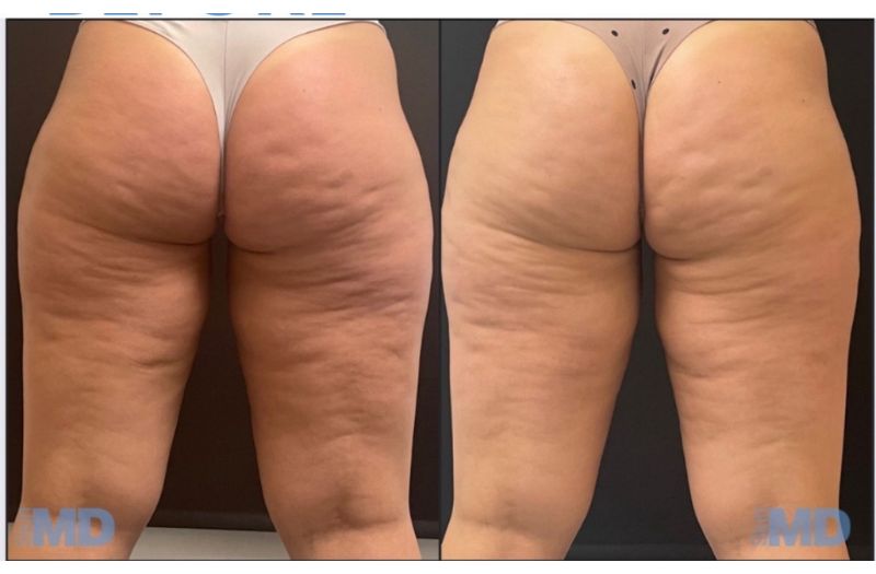 Morpheus8 – Body #2