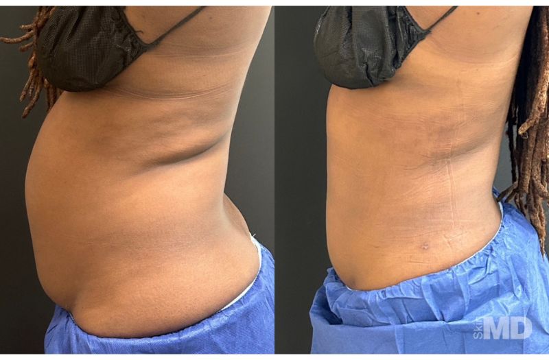 BodyTite Liposuction #6